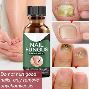 Nail Fungal Repair Serum | Nail Fungus Removal Gel